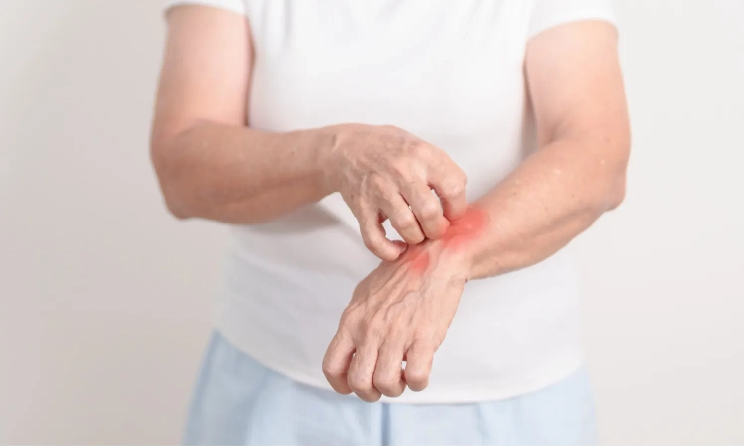 Viral! 2 WNI Terinfeksi Kusta di Rumania, Kasus Pertama Setelah 40 Tahun